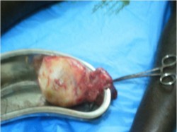 MASSE TESTICULAIRE