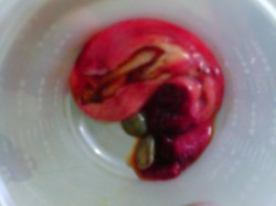 LITHIASE VESICULE BILIAIRE